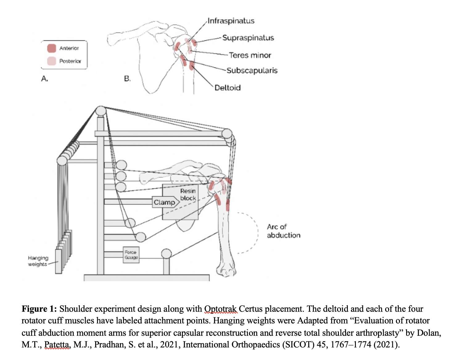 Cureus, Combined Deltoid and Spring Ligament Reconstruction Using the  Quadrangular Construct: Our Experience and Review of the Literature