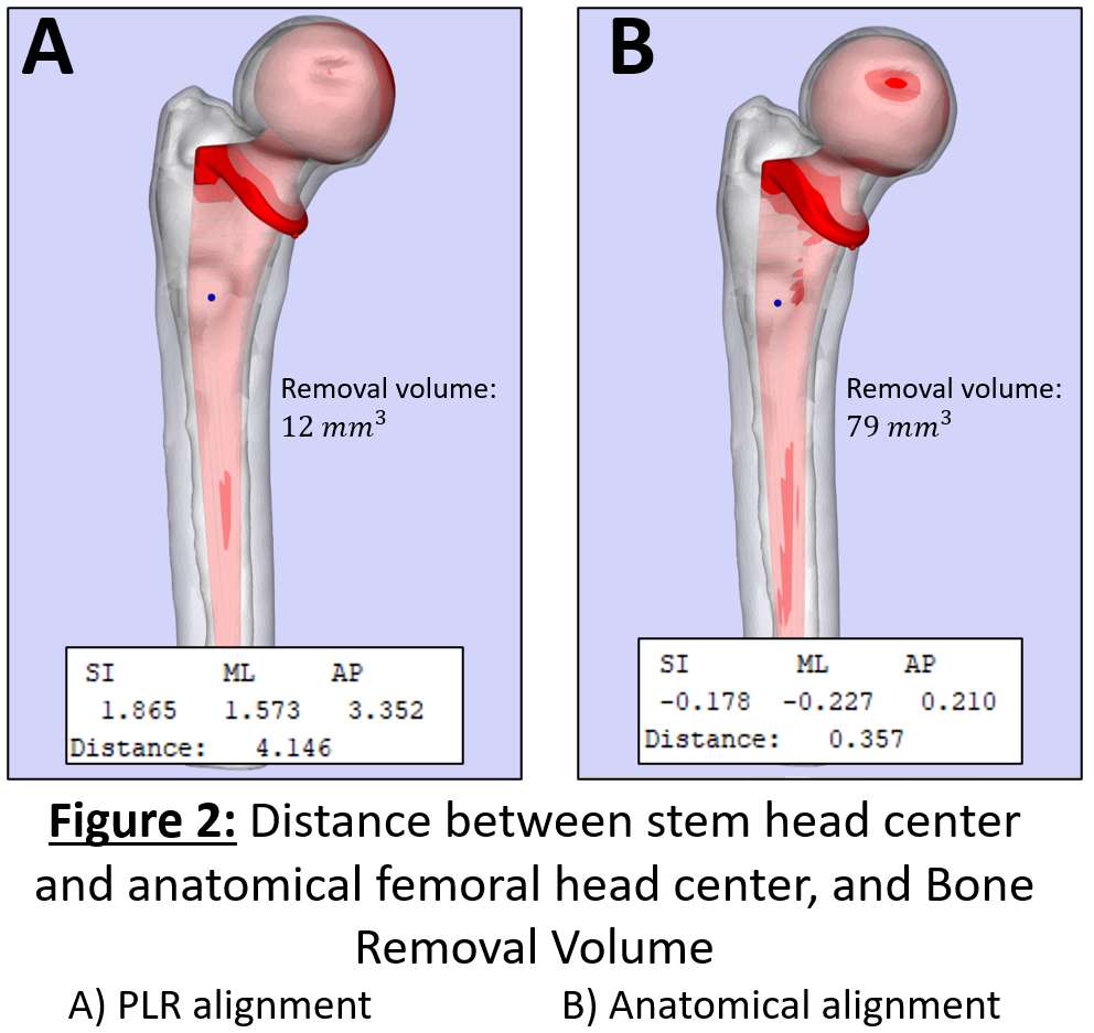 Impact of Joint Laxity Before Total Knee Arthroplasty on Postoperative  Ligament Balance