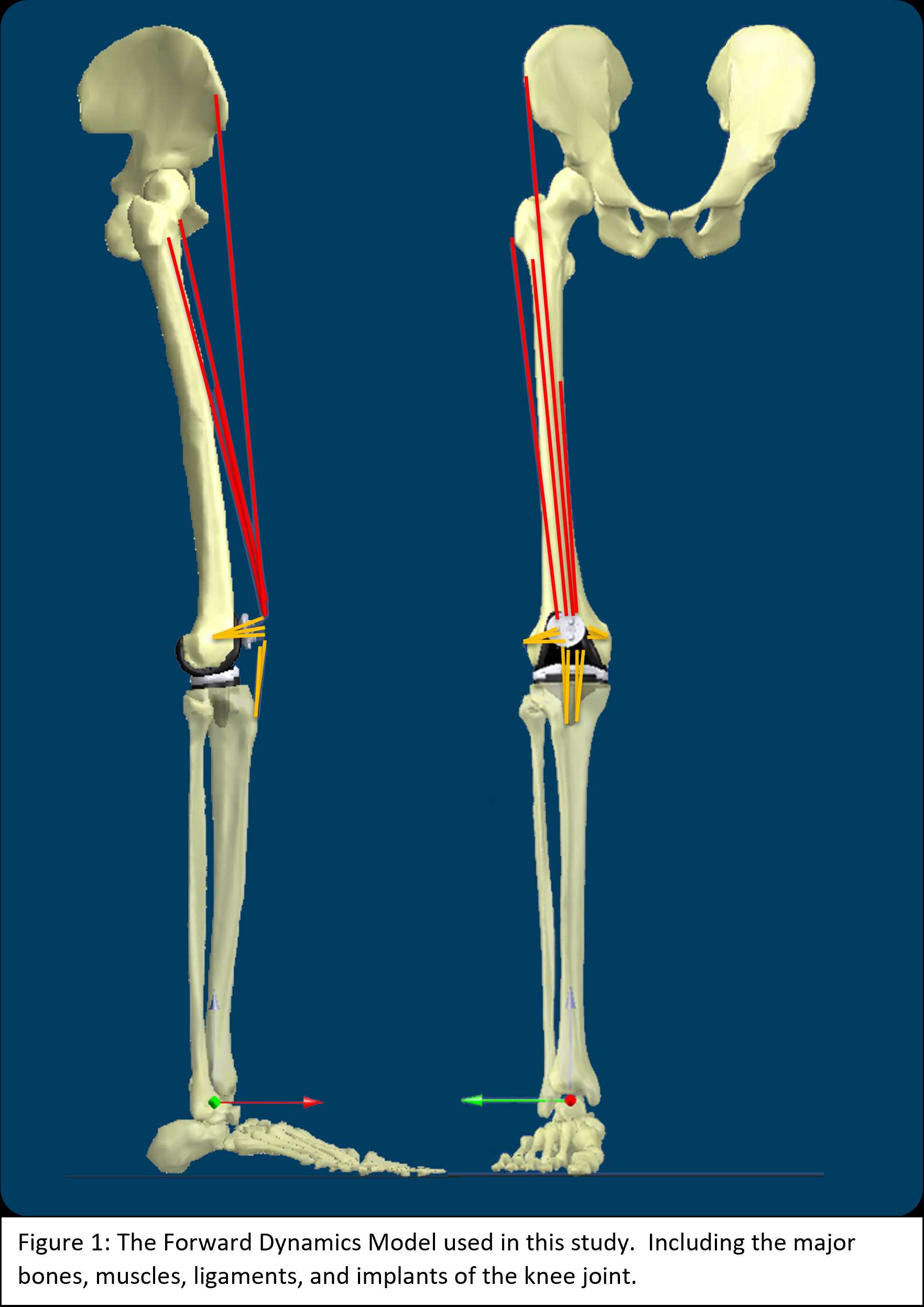 Impact of Joint Laxity Before Total Knee Arthroplasty on