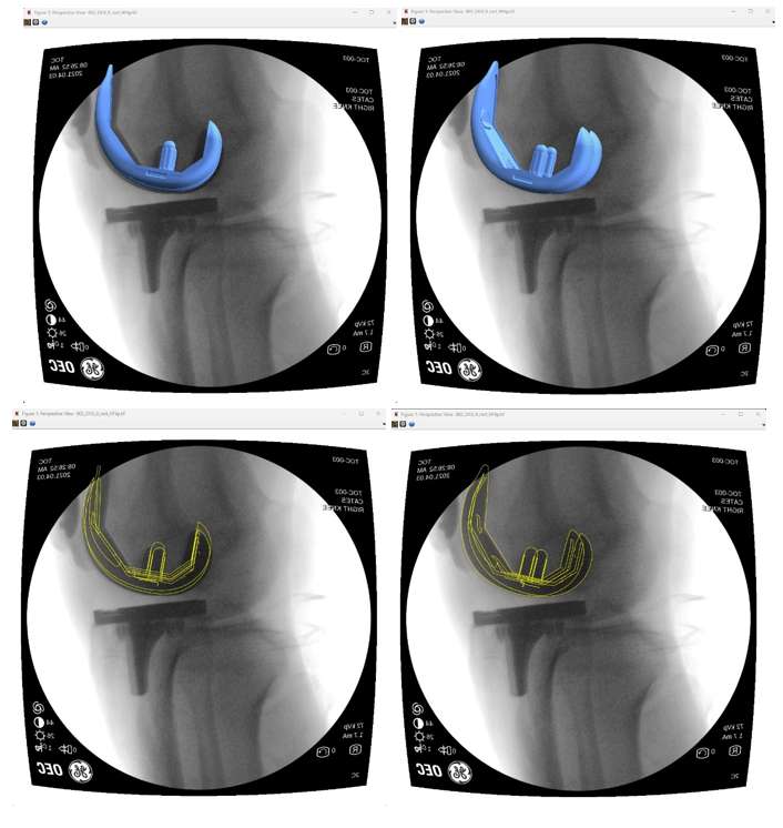 Delaying rotator cuff repair surgery more than 12 months may be associated  with worse outcomes — Michael Fu, MD - HSS Shoulder Surgery